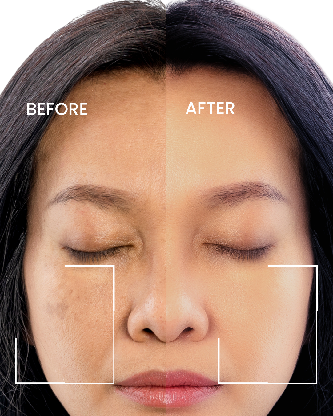 Dark Spot Corrector (OCU)