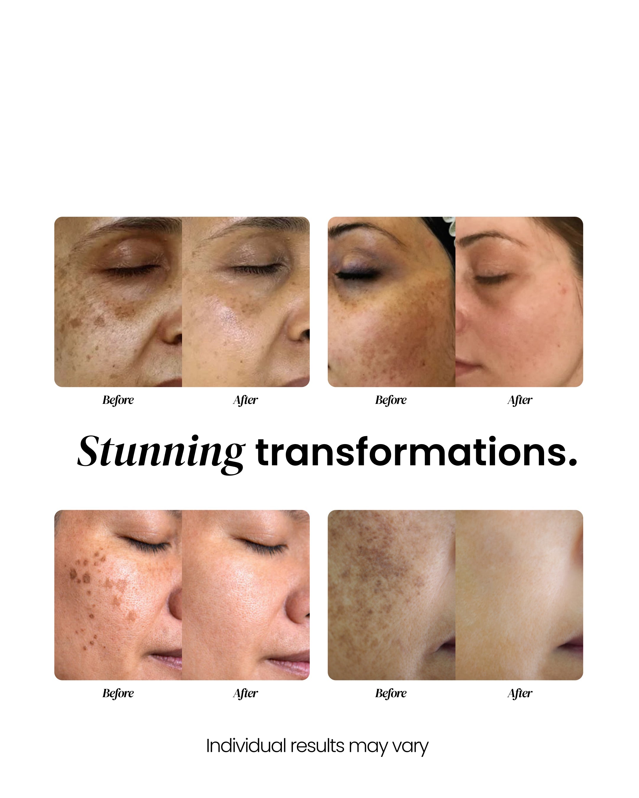 Dark Spot Corrector (OCU)